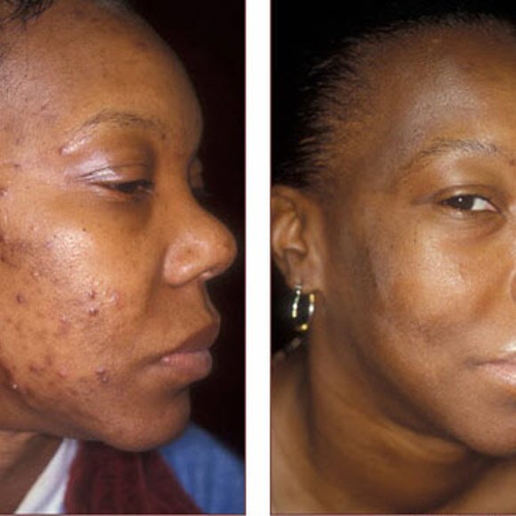 10% TCA Facial Peel - Picture 3 of 5